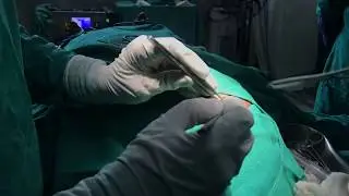 Sebaceous cyst surgery | minimal exiscion surgery | By Diwakar sir