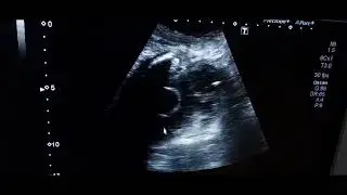 Prostatic Abscess on Ultrasound
