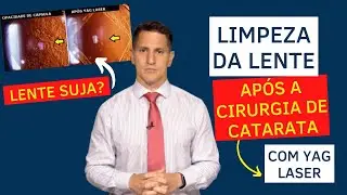 Limpeza da lente após cirurgia de catarata com Yag laser | Dr. Arthur Farache