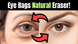 Erase Your Under-Eye Bags in Minutes: Natural Hacks Revealed!
