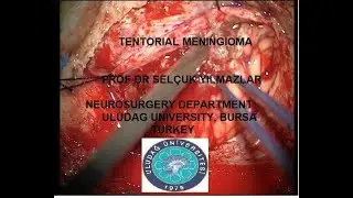 tentorial meningioma 584078
