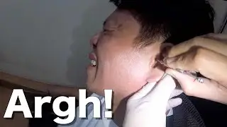 Attempting to Remove Solid Hard Earwax Stuck in Man's Ear