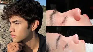 My Nose Job Experience in Turkey
