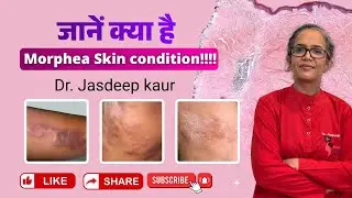 About Morphea Skin condition | Dr. Jasdeep kaur