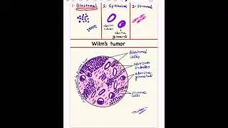 Let’s draw ✏️Wilm’s tumor histology | step by step| #microscopy| dr.mithila bisht