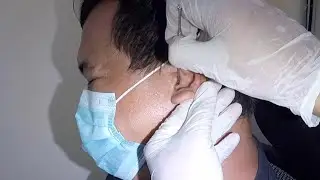 Stuck Something Removed from Man's Ear