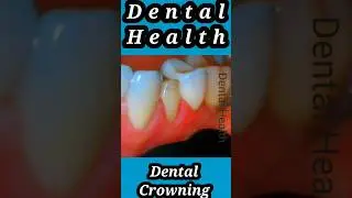 Dental Crowning #Shorts #tiktok #viralvideo #how #dental #foryou #reels #new