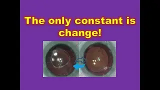 Novel technique for Intraocular Lens IOL exchange طريقة مبتكره لاستبدال عدسة العين