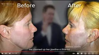 Revision Facelift - Face, Neck, Fat Grafting - Dr. Scott Holley #beforeafter