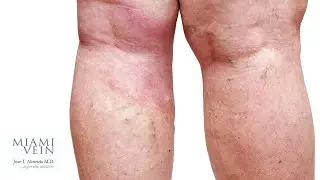 What is Lipodermatosclerosis and How is it Treated