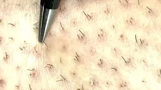 ingrown hair removal/hair plucked part 3