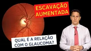 A relação do aumento de escavação com o glaucoma | Dr. Arthur Farache