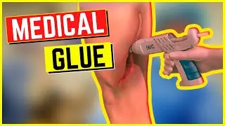 NEW MEDICAL GLUE TO STOP BLEEDING IN SECONDS| NEW MEDICAL INVENTION | ENGLISH | VIGNESH