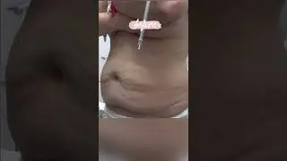 Tummy Tuck with Liposuction Before and Immediately After! 