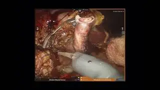 Gastroduodenopancreatectomia
