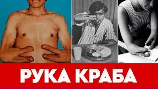 Операция по расщеплению руки? ЗАЧЕМ?