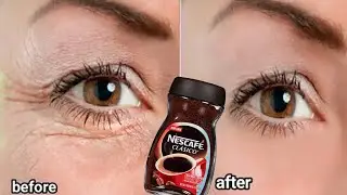 In 3 days Remove Under Eye Bags Completely | Remove Dark Circle, Wrinkles, Puffy Eyes