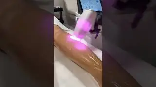 Отзыв от Абакумовой Альбины / Диодный лазер для эпиляции Wingderm