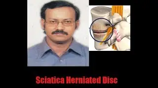 সায়াটিকা হোমিওপ্যাথি চিকিৎসা  | কোমর থেকে পায়ের যন্ত্রণা |  Sciatica Herniated Disc homeopathy