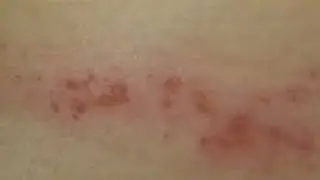 Sarasota man says doctors won't treat him for scabies, worries about infecting others
