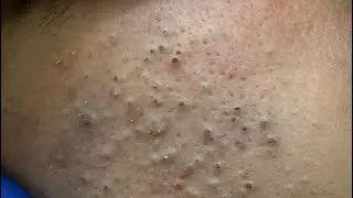 Deep Cleansing Techniques — Extreme Pimple Extraction And Facial Care