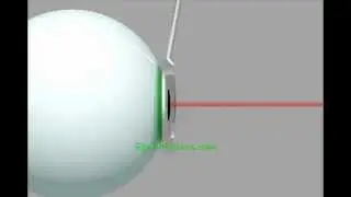 How Laser Eye Surgery Works