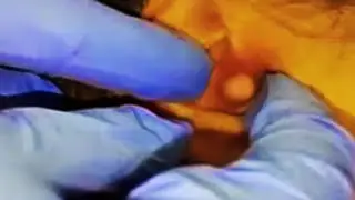 Chunky Ear Blackheads & Cysts; World's Worst Pimples, Whiteheads and Cysts