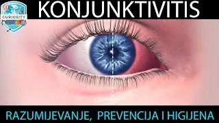 Akutni konjunktivitis Dr#116