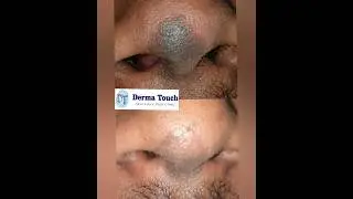 Birthmark removal from nose