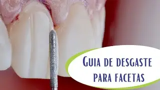 Guia de desgaste para preparo de facetas.
