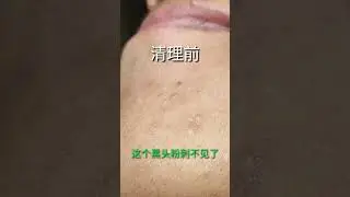 Best Satifying videos for Relaxation with Rat Tana Acne Spa =Short