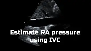 IVC for RA pressure - Echocardiography