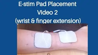 Stroke Recovery- Electrical stimulation pad placement for wrist and finger extension
