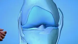 Runner’s Knee Injury