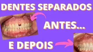 Aparelho Antes e Depois (dentes separados)