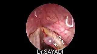 Resection d'un polype de la corde vocale droite