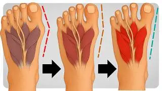 How to Fix Bunions in 5 Steps
