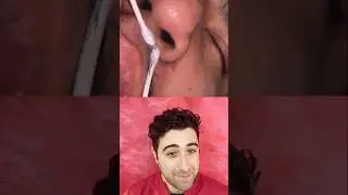 Double Q tip extraction under nose - good technique ?