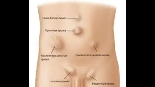 Грыжа передней брюшной стенки на УЗИ (17-7-19)