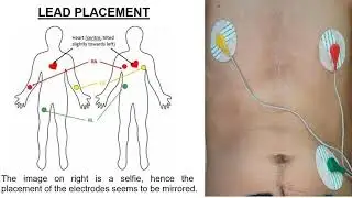 IoT-Based Remote Patient Monitoring System to Measure Vital Body Signs