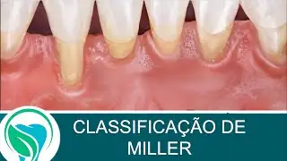 Classificação e prognóstico das recessões gengivais