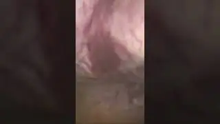 Cancer Endometrial Focal
