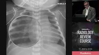Non-accidental Injury (rib fracture) - Radiology Review Course
