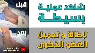 شاهد عملية بسيطة لإطالة و تجميل العضو الذكري/ برنامج الدعامة - الحلقة الثامنة عشر