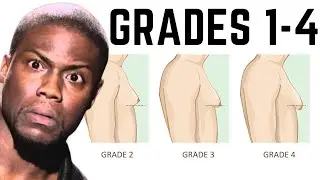 Gynecomastia Demystified: Grading and Treatments