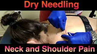 Dry Needling the Neck and Shoulder