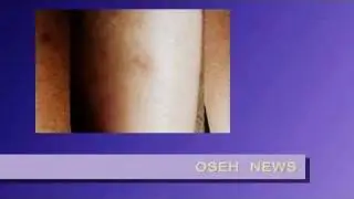 OSEH NEWS - DEW ATTACKS EVIDENCES