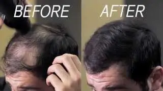 Hair Fibers Self Applied by Male | Eclipse Instant Hair Filler