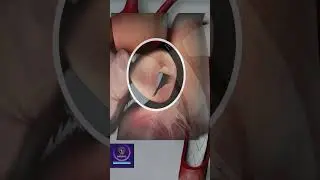Aortic Valve - 3D animation
