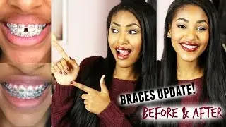 Braces Update! Before & After